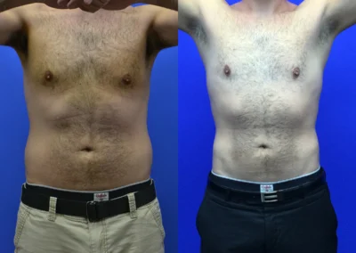 Liposuction before and after photos by Cabbabe Plastic Surgery in Saint Louis, MO