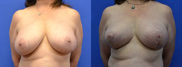 Oncoplastic before and after photos by Cabbabe Plastic Surgery in Saint Louis, MO