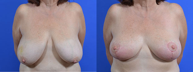 Oncoplastic before and after photos by Cabbabe Plastic Surgery in Saint Louis, MO