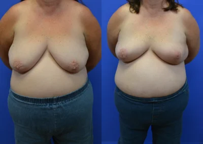 Oncoplastic before and after photos by Cabbabe Plastic Surgery in Saint Louis, MO