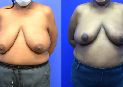 Oncoplastic before and after photos by Cabbabe Plastic Surgery in Saint Louis, MO