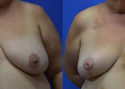 Oncoplastic before and after photos by Cabbabe Plastic Surgery in Saint Louis, MO
