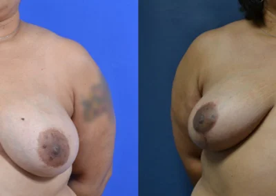 Oncoplastic before and after photos by Cabbabe Plastic Surgery in Saint Louis, MO