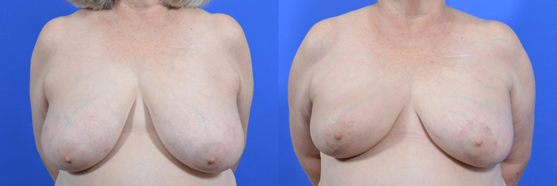 Oncoplastic before and after photos by Cabbabe Plastic Surgery in Saint Louis, MO