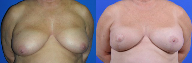 Oncoplastic before and after photos by Cabbabe Plastic Surgery in Saint Louis, MO