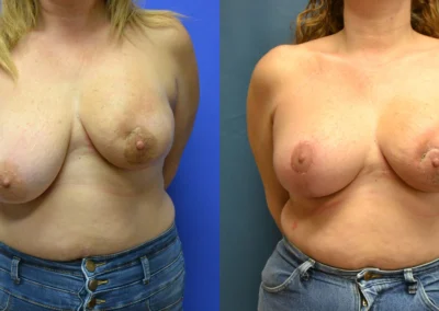 Reconstructive Revision Breast Surgery before and after photos by Cabbabe Plastic Surgery in Saint Louis, MO