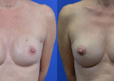 Reconstructive Revision Breast Surgery before and after photos by Cabbabe Plastic Surgery in Saint Louis, MO