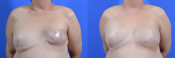 Reconstructive Revision Breast Surgery before and after photos by Cabbabe Plastic Surgery in Saint Louis, MO