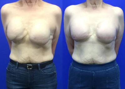 Reconstructive Revision Breast Surgery before and after photos by Cabbabe Plastic Surgery in Saint Louis, MO