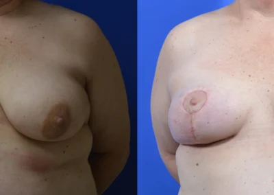 Reconstructive Revision Breast Surgery before and after photos by Cabbabe Plastic Surgery in Saint Louis, MO
