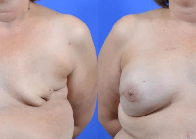 Reconstructive Revision Breast Surgery before and after photos by Cabbabe Plastic Surgery in Saint Louis, MO