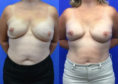 Reconstructive Revision Breast Surgery before and after photos by Cabbabe Plastic Surgery in Saint Louis, MO
