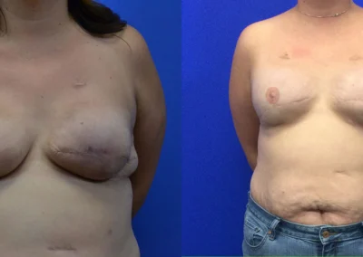 Reconstructive Revision Breast Surgery before and after photos by Cabbabe Plastic Surgery in Saint Louis, MO
