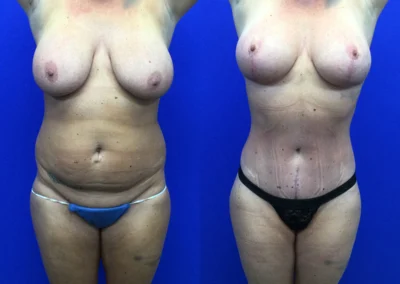 Lower Body Lift before and after photos by Cabbabe Plastic Surgery in Saint Louis, MO