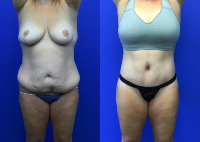 Lower Body Lift before and after photos by Cabbabe Plastic Surgery in Saint Louis, MO
