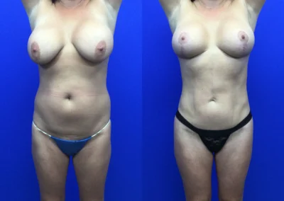 Mini Tummy Tuck before and after photos by Cabbabe Plastic Surgery in Saint Louis, MO