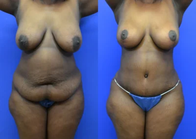 Mommy Makeover before and after photos by Cabbabe Plastic Surgery in Saint Louis, MO