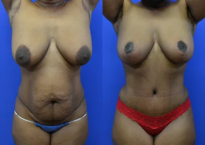 Mommy Makeover before and after photos by Cabbabe Plastic Surgery in Saint Louis, MO
