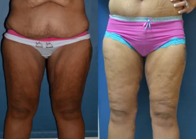 Thigh Lift before and after photos by Cabbabe Plastic Surgery in Saint Louis, MO
