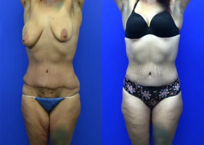 Thigh Lift before and after photos by Cabbabe Plastic Surgery in Saint Louis, MO