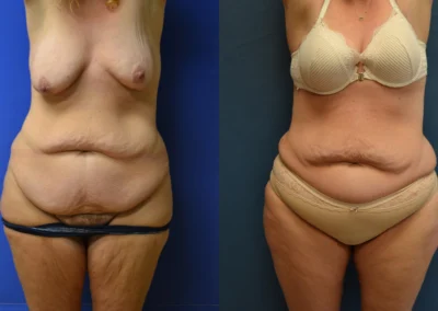 Thigh Lift before and after photos by Cabbabe Plastic Surgery in Saint Louis, MO