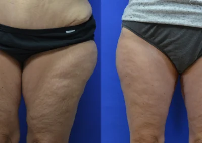 Thigh Lift before and after photos by Cabbabe Plastic Surgery in Saint Louis, MO