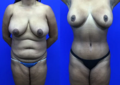 Tummy Tuck before and after photos by Cabbabe Plastic Surgery in Saint Louis, MO