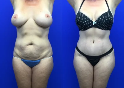 Tummy Tuck before and after photos by Cabbabe Plastic Surgery in Saint Louis, MO