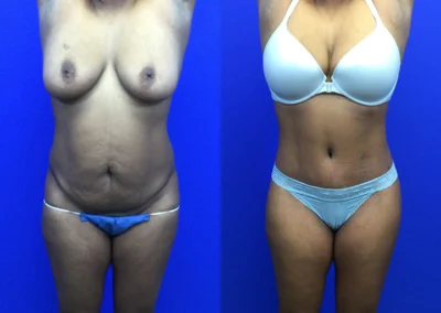 Tummy Tuck before and after photos by Cabbabe Plastic Surgery in Saint Louis, MO