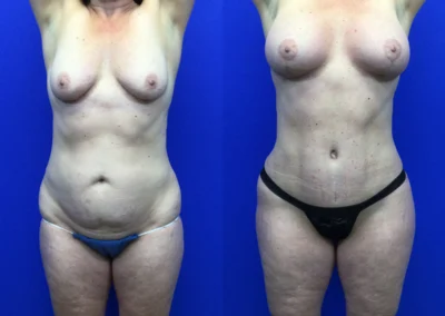 Tummy Tuck before and after photos by Cabbabe Plastic Surgery in Saint Louis, MO