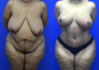 Tummy Tuck before and after photos by Cabbabe Plastic Surgery in Saint Louis, MO