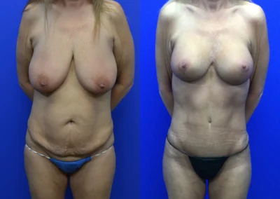 Tummy Tuck before and after photos by Cabbabe Plastic Surgery in Saint Louis, MO