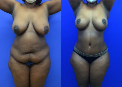 Tummy Tuck before and after photos by Cabbabe Plastic Surgery in Saint Louis, MO