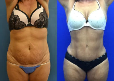 Tummy Tuck before and after photos by Cabbabe Plastic Surgery in Saint Louis, MO