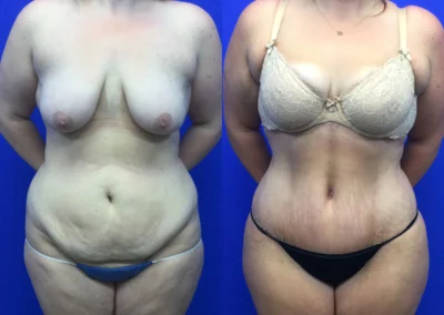 Tummy Tuck before and after photos by Cabbabe Plastic Surgery in Saint Louis, MO