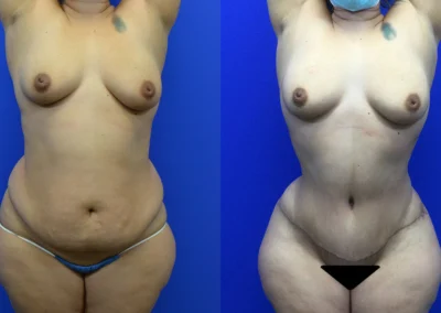 Tummy Tuck before and after photos by Cabbabe Plastic Surgery in Saint Louis, MO