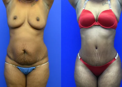 Tummy Tuck before and after photos by Cabbabe Plastic Surgery in Saint Louis, MO