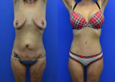 Tummy Tuck before and after photos by Cabbabe Plastic Surgery in Saint Louis, MO