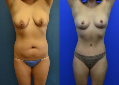 Tummy Tuck before and after photos by Cabbabe Plastic Surgery in Saint Louis, MO