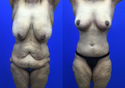 Fleur-de-lis tummy tuck before and after photos by Cabbabe Plastic Surgery in Saint Louis, MO