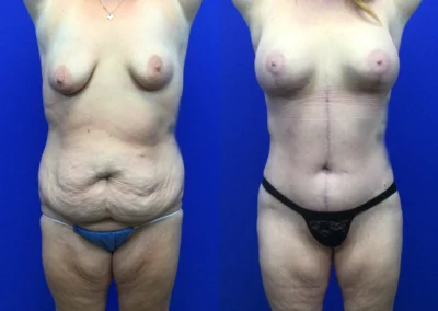 Fleur-de-lis tummy tuck before and after photos by Cabbabe Plastic Surgery in Saint Louis, MO