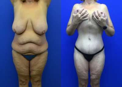 Fleur-de-lis tummy tuck before and after photos by Cabbabe Plastic Surgery in Saint Louis, MO