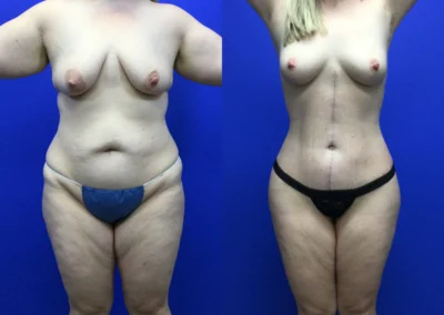 Fleur-de-lis tummy tuck before and after photos by Cabbabe Plastic Surgery in Saint Louis, MO