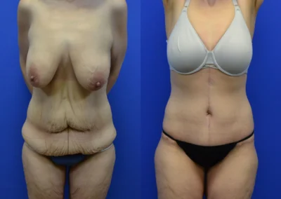 Fleur-de-lis tummy tuck before and after photos by Cabbabe Plastic Surgery in Saint Louis, MO