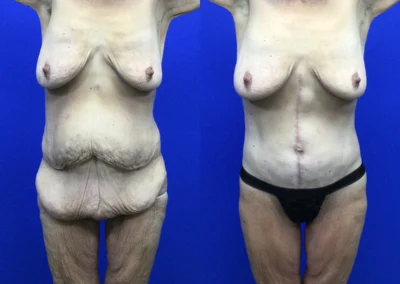 Fleur-de-lis tummy tuck before and after photos by Cabbabe Plastic Surgery in Saint Louis, MO