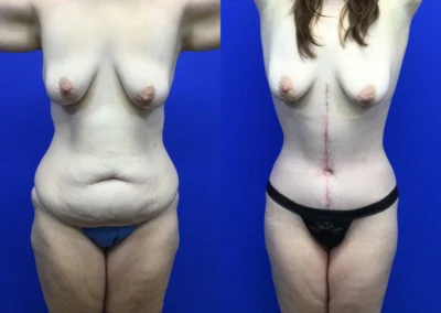 Fleur-de-lis tummy tuck before and after photos by Cabbabe Plastic Surgery in Saint Louis, MO
