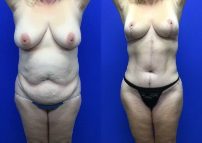 Fleur-de-lis tummy tuck before and after photos by Cabbabe Plastic Surgery in Saint Louis, MO