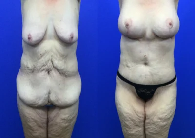 Fleur-de-lis tummy tuck before and after photos by Cabbabe Plastic Surgery in Saint Louis, MO