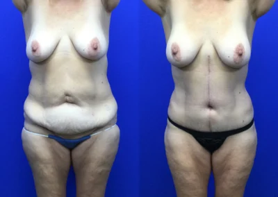 Fleur-de-lis tummy tuck before and after photos by Cabbabe Plastic Surgery in Saint Louis, MO