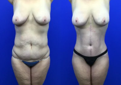 Fleur-de-lis tummy tuck before and after photos by Cabbabe Plastic Surgery in Saint Louis, MO